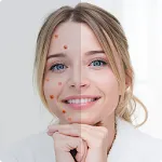 Remove Acne from Face